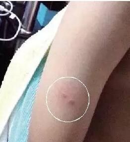 厦门2岁幼童右手臂现小圆点 疑被老师用针扎伤 厦门2岁幼童右手臂现小圆点 疑被老师用针扎伤