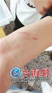 ▲被打女生的伤痕仍可见 ▲被打女生的伤痕仍可见