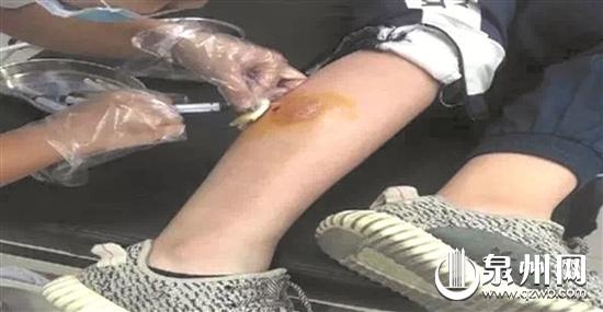 学生被狗咬后接种狂犬疫苗